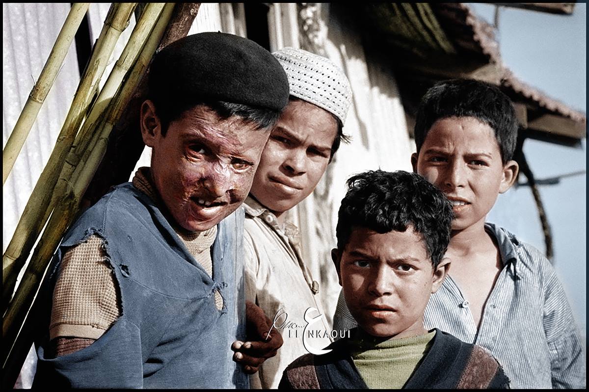 صورة التقطت سنة 1962 لطفل أصيب بالنبالم في منطقة القبائل.