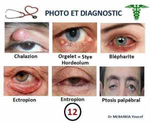 Chalazion Orgelet Ectropion Entropion Blépharite