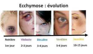 Blessures : ecchymoses : évolution