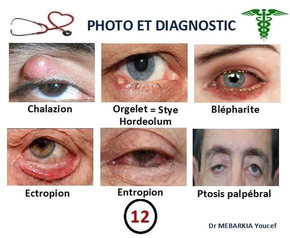 Chalazion Orgelet Ectropion Entropion Blépharite