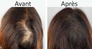 Traitement Des Pertes De Cheveux en Turquie