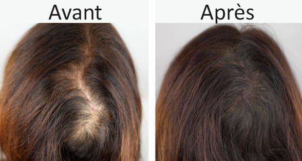 Traitement Des Pertes De Cheveux en Turquie